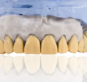 Licowki kompozytowe czy porcelanowe – ktore wybrac