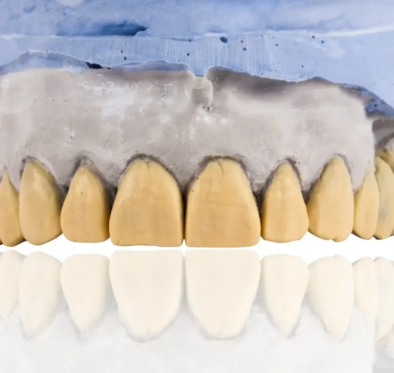 Licowki kompozytowe czy porcelanowe – ktore wybrac